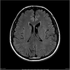 Brain MRI scan without tumor
