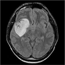 Brain MRI scan with tumor
